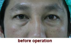 plastic-surgery-blepharoplasty