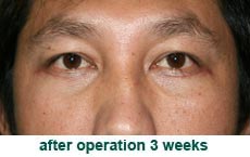 plastic-surgery-blepharoplasty