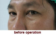 plastic-surgery-blepharoplasty