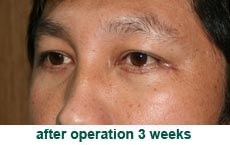 plastic-surgery-blepharoplasty