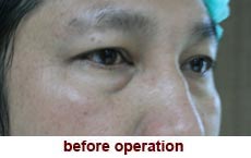 plastic-surgery-blepharoplasty