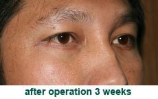 plastic-surgery-blepharoplasty