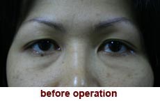 plastic-surgery-blepharoplasty