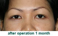 plastic-surgery-blepharoplasty