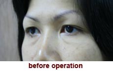 plastic-surgery-blepharoplasty