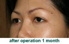 plastic-surgery-blepharoplasty