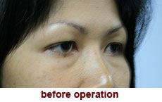 plastic-surgery-blepharoplasty