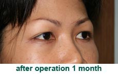 plastic-surgery-blepharoplasty