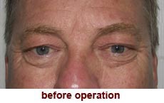 plastic-surgery-blepharoplasty