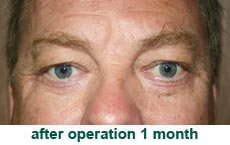 plastic-surgery-blepharoplasty