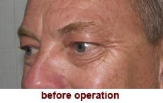 plastic-surgery-blepharoplasty