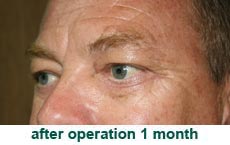 plastic-surgery-blepharoplasty