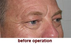 plastic-surgery-blepharoplasty