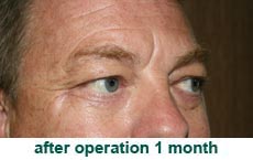 plastic-surgery-blepharoplasty