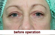 plastic-surgery-blepharoplasty