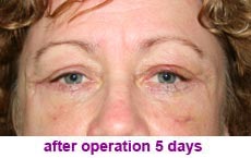 plastic-surgery-blepharoplasty