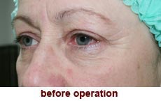 plastic-surgery-blepharoplasty