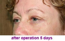 plastic-surgery-blepharoplasty