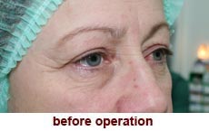 plastic-surgery-blepharoplasty