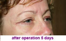 plastic-surgery-blepharoplasty