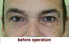 plastic-surgery-blepharoplasty