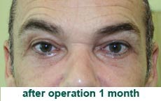 plastic-surgery-blepharoplasty