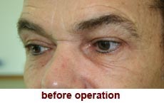 plastic-surgery-blepharoplasty