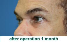 plastic-surgery-blepharoplasty