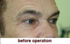 plastic-surgery-blepharoplasty