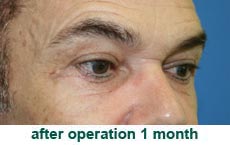 plastic-surgery-blepharoplasty