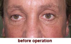 plastic-surgery-blepharoplasty