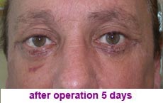 plastic-surgery-blepharoplasty