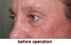 plastic-surgery-blepharoplasty