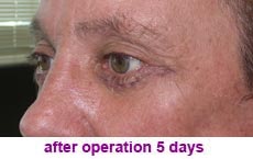 plastic-surgery-blepharoplasty