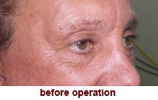 plastic-surgery-blepharoplasty