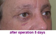 plastic-surgery-blepharoplasty