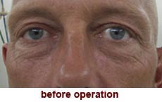 plastic-surgery-blepharoplasty