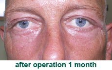 plastic-surgery-blepharoplasty