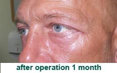 plastic-surgery-blepharoplasty