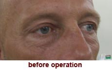 plastic-surgery-blepharoplasty