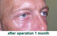 plastic-surgery-blepharoplasty