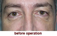 plastic-surgery-blepharoplasty