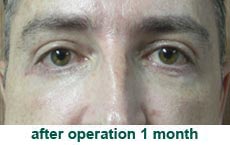 plastic-surgery-blepharoplasty