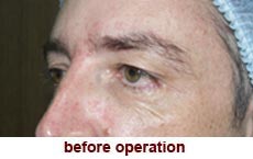 plastic-surgery-blepharoplasty