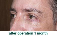 plastic-surgery-blepharoplasty