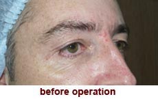 plastic-surgery-blepharoplasty