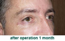 plastic-surgery-blepharoplasty