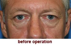 plastic-surgery-blepharoplasty