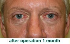 plastic-surgery-blepharoplasty