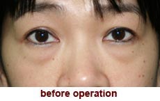 plastic-surgery-blepharoplasty